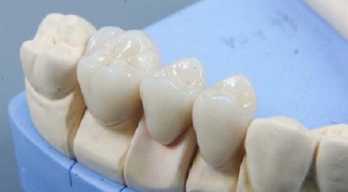 Bridgeworks In Dental Prosthetics