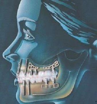 Dental Implantation Methods