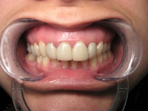 How Can CEREC Restoration Help In Fixing Dental Problems?