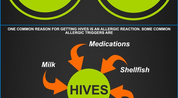 Hives Cause And Treatments