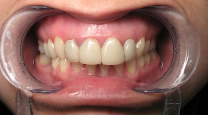How Can CEREC Restoration Help In Fixing Dental Problems?